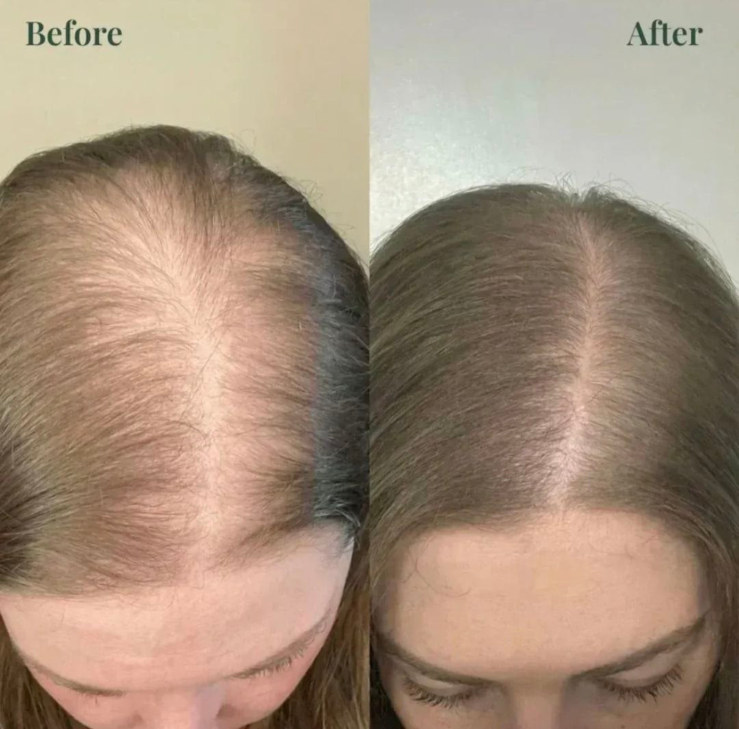 (BUY 1 GET 1 FREE) Kerarose® - Magic Rosemary Hair Growth Shampoo